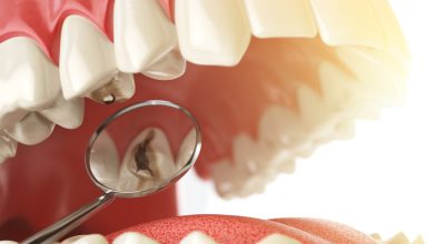 جرم دندان چیست و جرمگیری چه مراحلی دارد؟