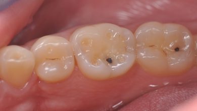 فرسایش مینای دندان: علل ، علائم و درمان