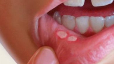 درمان آفت دهان با شیره نارگیل