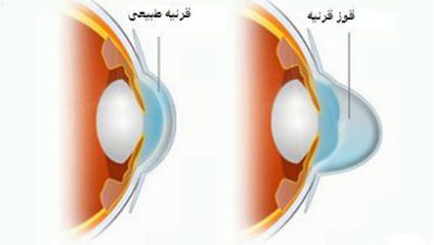 روش درمان دوربینی چشم یا هایپروپی