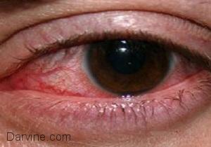 علت لکه های قرمز خون در داخل چشم